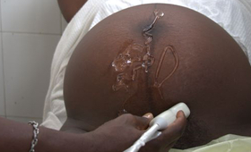 A woman during an ultrasound